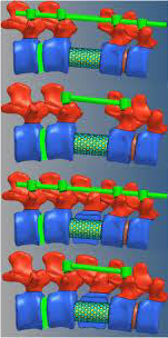 analise-elementos-finitos-com-dispositivos-de-fixacao-em-coluna