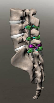 elementos-finitos-em-coluna-vertebral